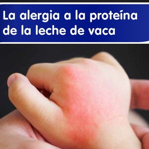 La alergia a la proteína de la leche de vaca