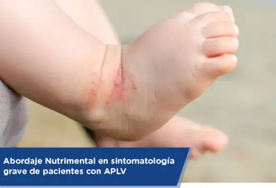 Abordaje Nutrimental en sintomatología grave de pacientes con APLV (infographics)