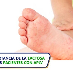 Importancia de la lactosa en los pacientes con APLV (infographics)