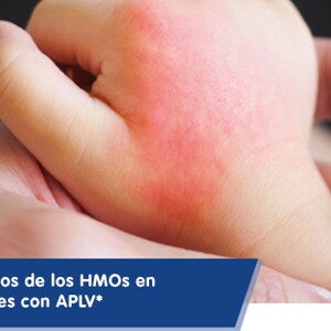 Beneficios de los HMOs en pacientes con APLV (infographics)
