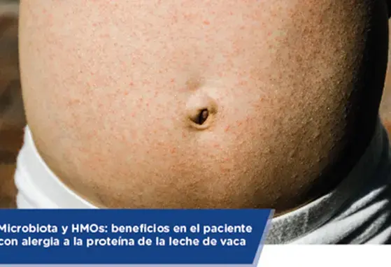 Microbiota y HMOs: beneficios en el paciente con alergia a la proteína de la leche de vaca (infographics)